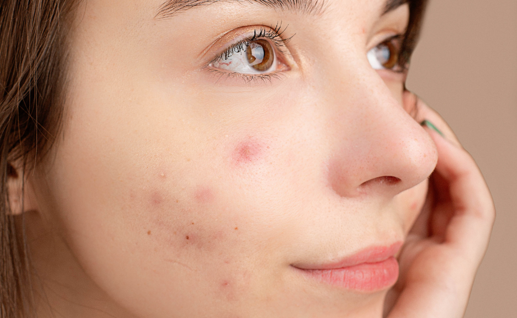 Acne adulta: perché può peggiorare con il caldo